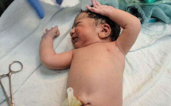 Neugeborenes bei der ersten Untersuchung: U1